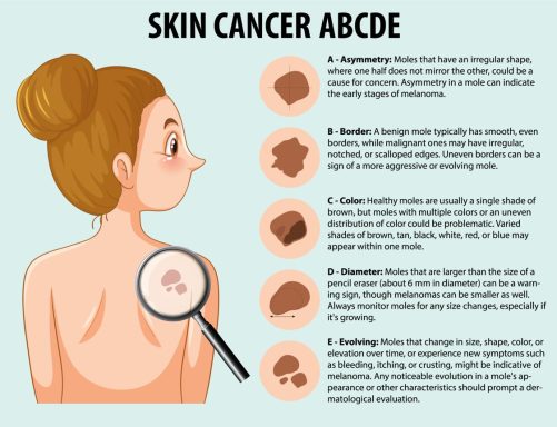 Illustration explaining the ABCDE rules for identifying skin cancer.